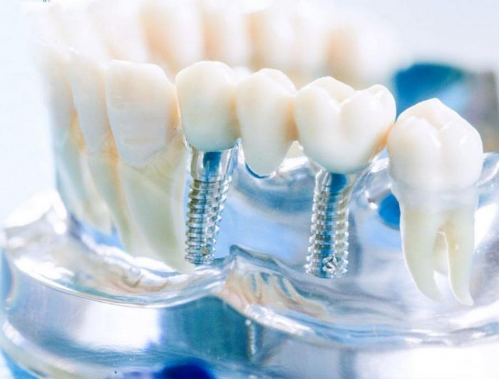 Имплантация и протезирование зубов фото